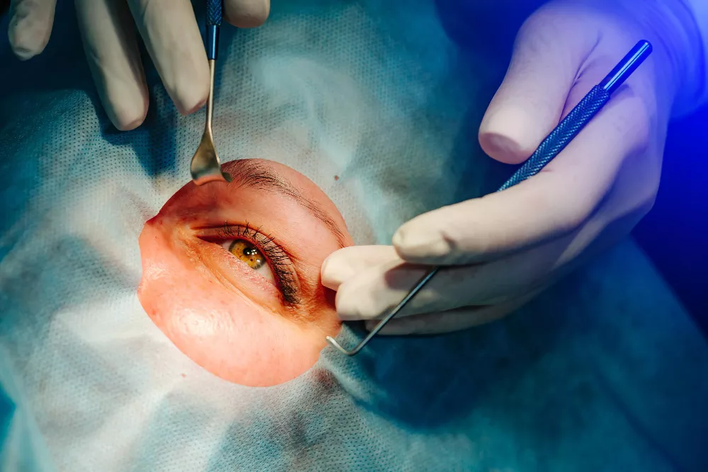 Cataract Surgery